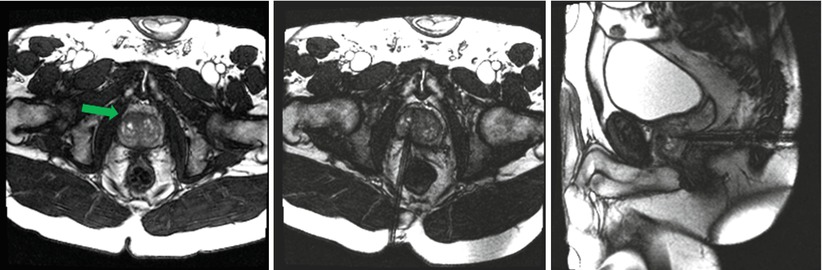 MRI-Guided Prostate Biopsy | Radiology Key