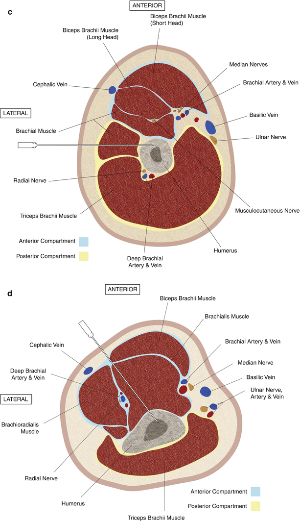 Anatomic Guidelines and Approaches for Biopsy of the Long Bones ...