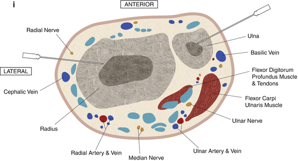 Anatomic Guidelines and Approaches for Biopsy of the Long Bones