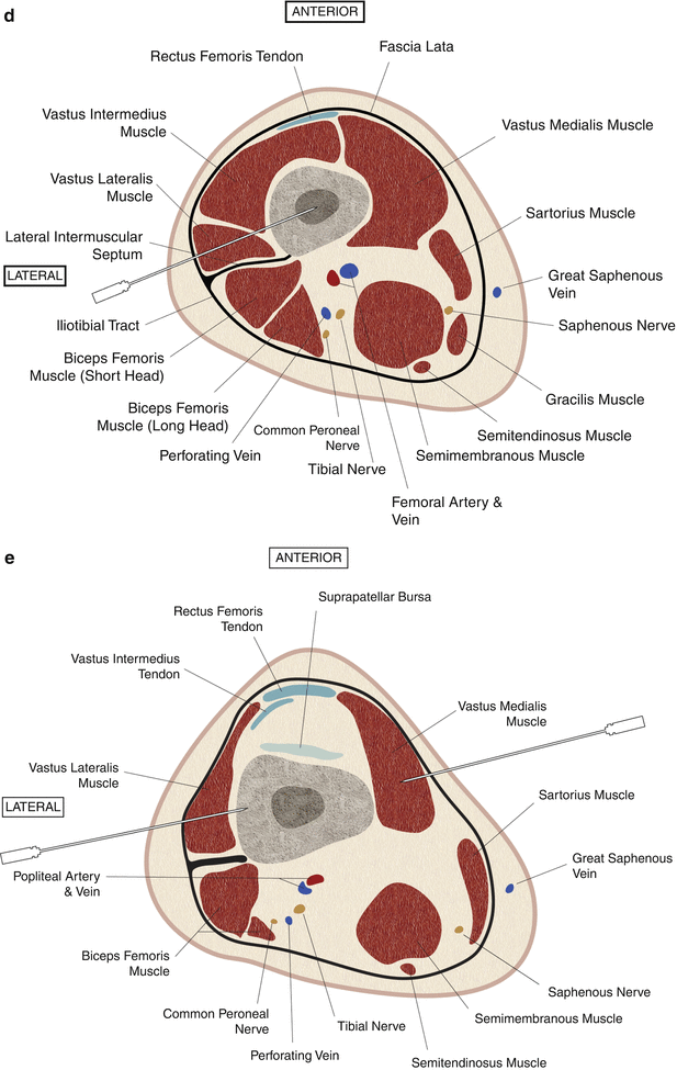 Anatomic Guidelines and Approaches for Biopsy of the Long Bones ...