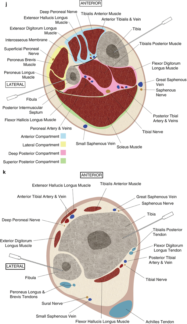 Anatomic Guidelines and Approaches for Biopsy of the Long Bones ...