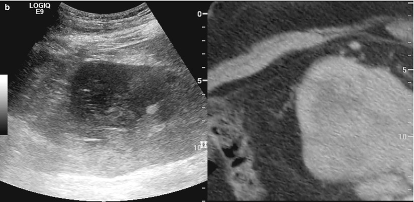 Ultrasound-Guided Biopsy | Radiology Key