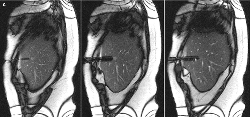 MRI-Guided Biopsy | Radiology Key