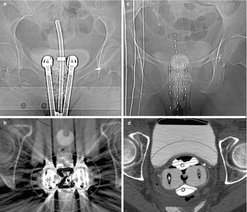 image-guided-brachytherapy-radiology-key