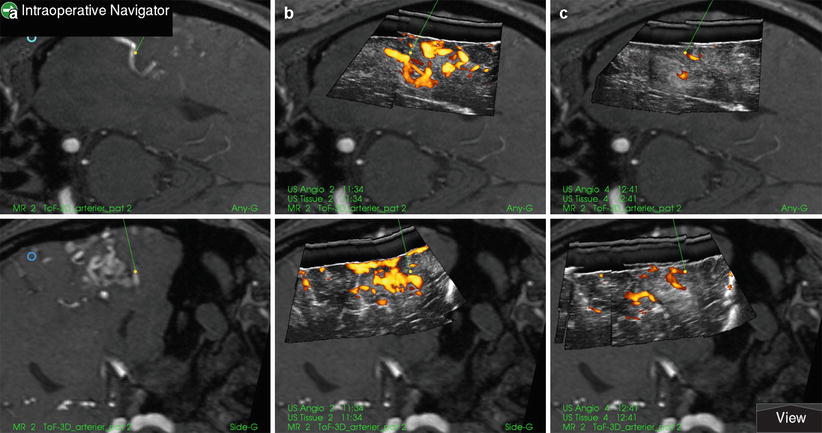 Intraoperative Ultrasound In Neurosurgery | Radiology Key