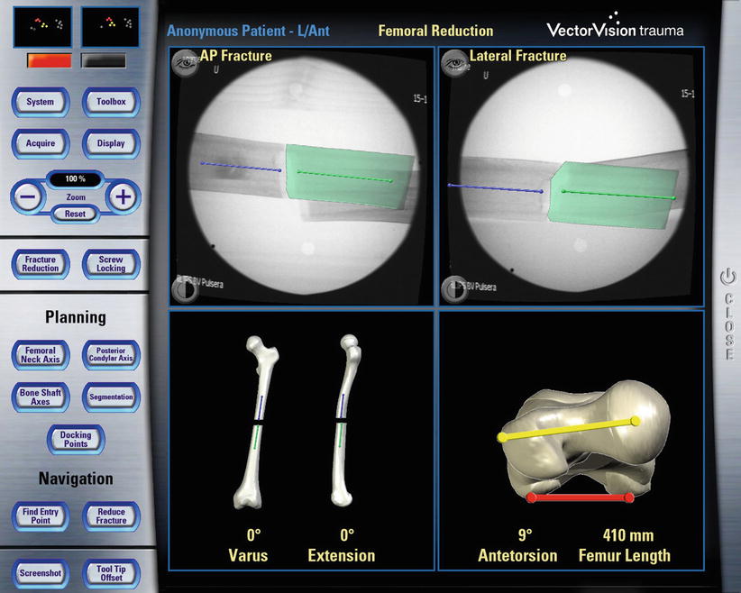 Screenshot from the InLine Orthopaedics navigation system