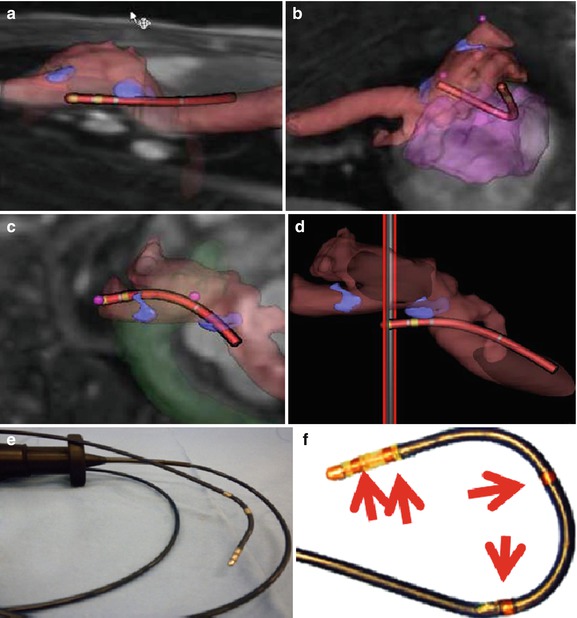 ImageGuided Cardiac Electrophysiology Procedures Focusing on MRI