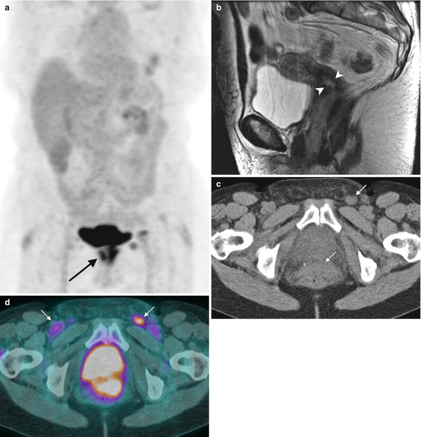 PET-CT Imaging in Gynecologic Malignancies | Radiology Key