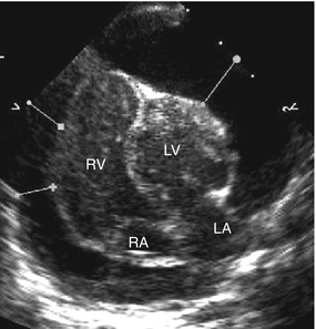 Basics Of Paediatric Echocardiography | Radiology Key