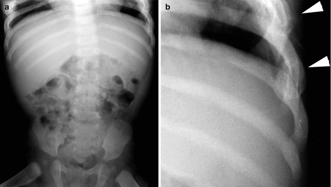 Battered Child Syndrome Non accidental Trauma Radiology Key