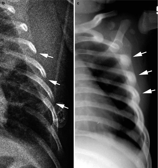 Battered Child Syndrome Non accidental Trauma Radiology Key