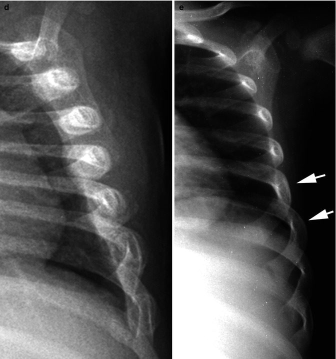 battered-child-syndrome-non-accidental-trauma-radiology-key