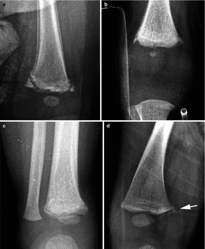 battered-child-syndrome-non-accidental-trauma-radiology-key