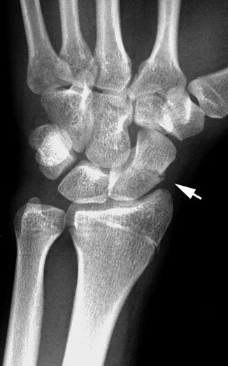 Wrist and Hand | Radiology Key