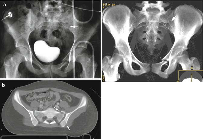 Abdominal CT scan: fracture of the left iliac crest (arrow