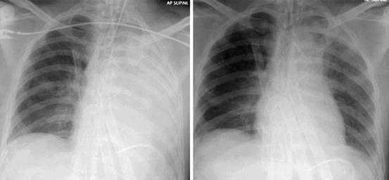 Persistent Hypoxemia Despite Intervention | Radiology Key