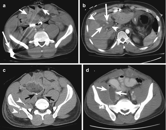 Penetrating Abdominal Trauma Radiology Key