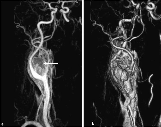 Clinical Mra Of The Carotid Arteries Radiology Key