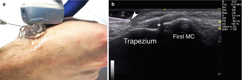 Wrist Injection Radiology Wrist and Hand | Radiology Key