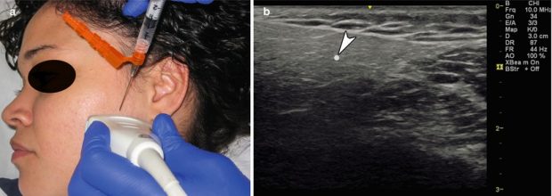 Trigger Point Injections | Radiology Key