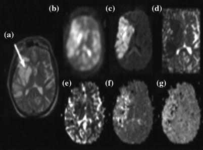 Practical Illustrations Sodium Spectroscopy and Imaging: Clinical ...