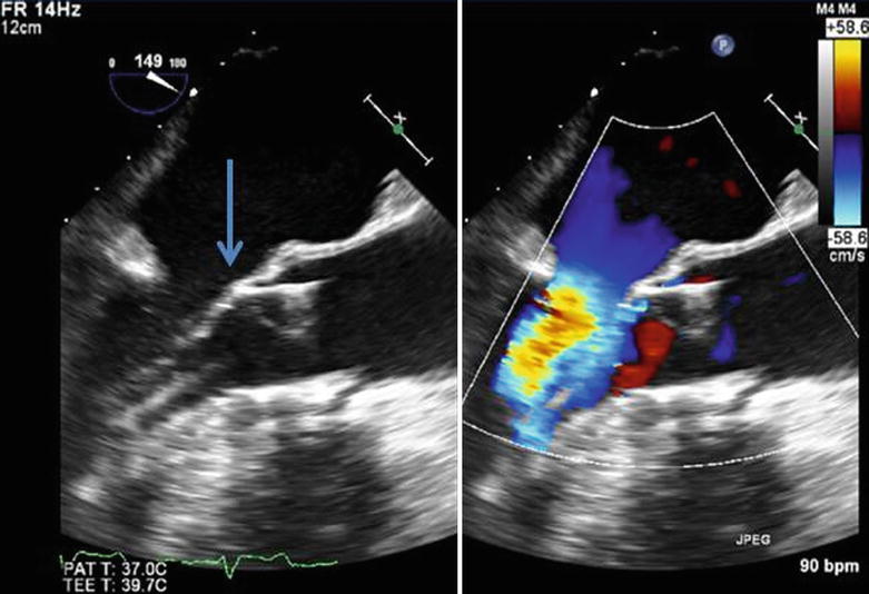 CaseBased Examples of Complications Associated with Transcatheter