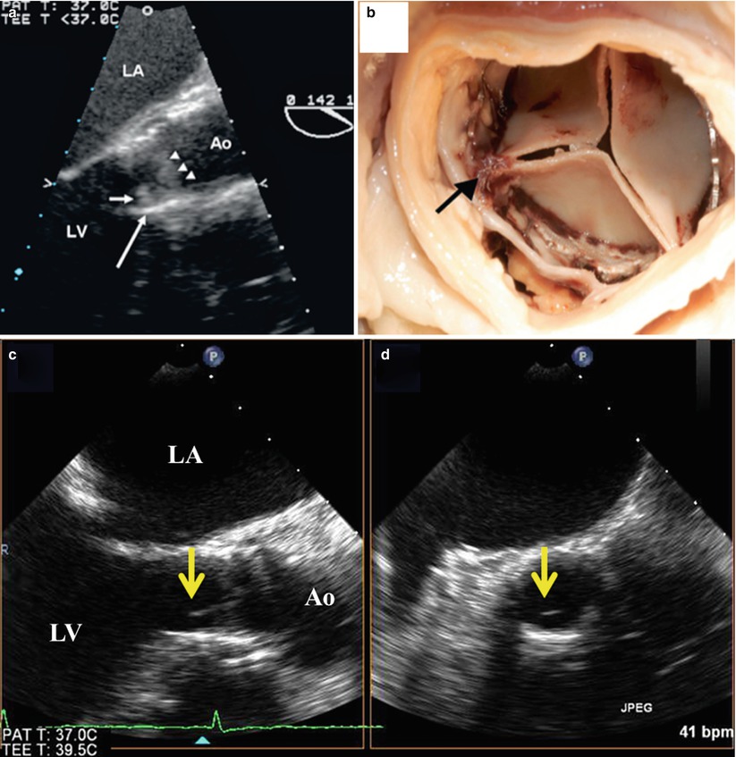 Structural And Hemodynamic Integrity Of The Implanted TAVR Valve ...