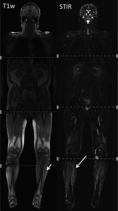 MRI For Evaluation Of The Entire Muscular System | Radiology Key