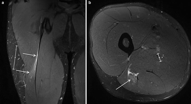 Muscle Injury  Radiology Key