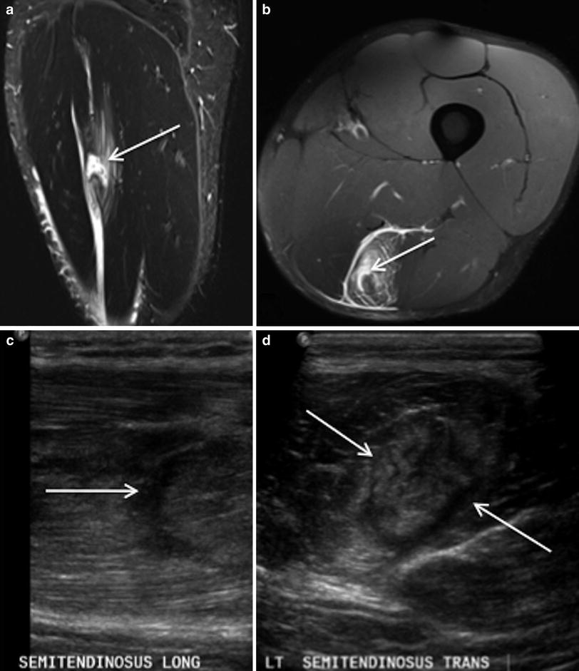 Muscle Injury  Radiology Key