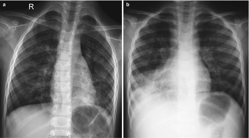mycoplasma pneumonia chest x ray findings