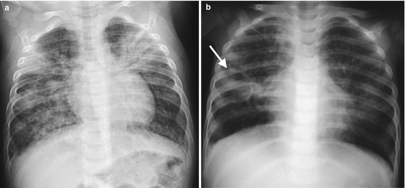 Infections | Radiology Key