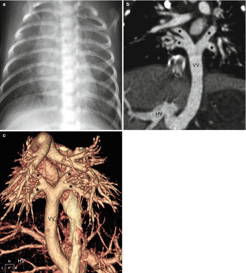 Congenital Thoracic Vascular Anomalies And Associated Airway Diseases