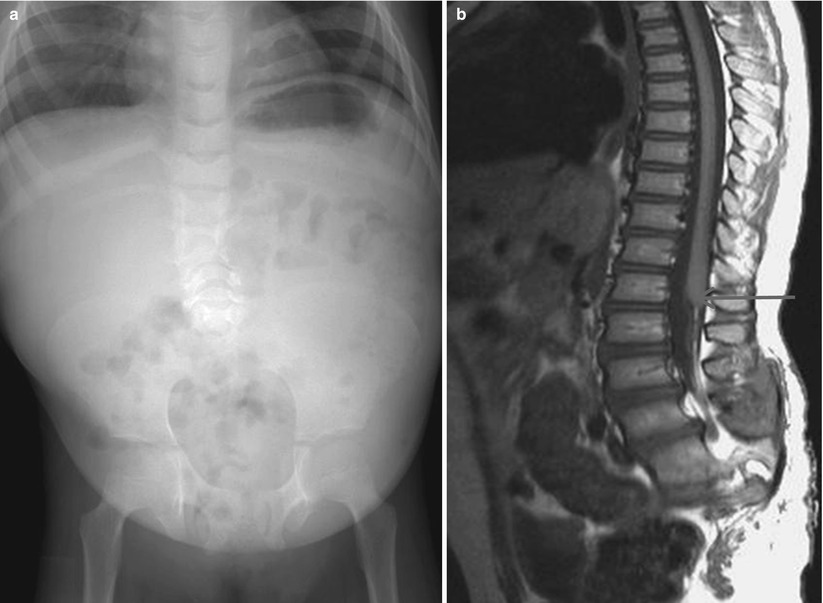 Congenital Anomalies Of The Brain And Spinal Cord | Radiology Key