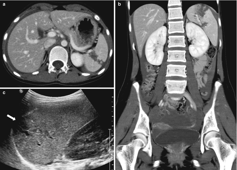 Liver Biliary Tract Pancreas And Spleen Radiology Key