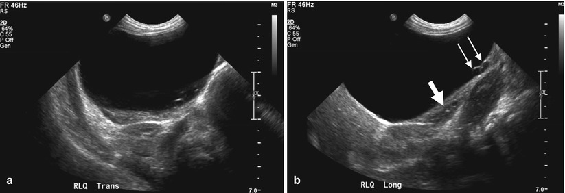 pediatric-uterus-ovary-and-testis-diseases-radiology-key