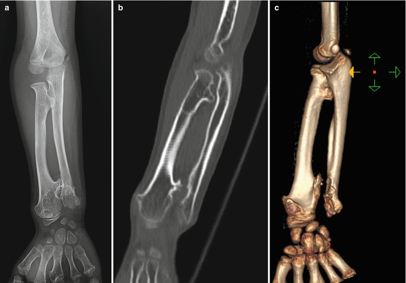 Рак кости ноги. Перелом малой берцовой кости. Костная киста пяточной кости кт. Остеома кости голени рентген.
