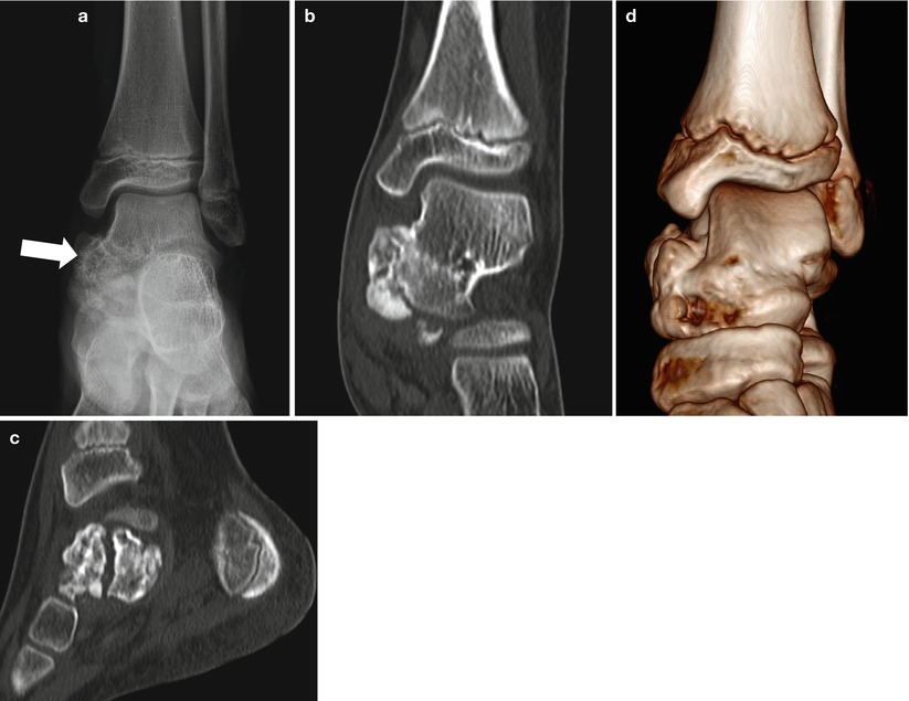 Pediatric Bone Tumors Radiology Key