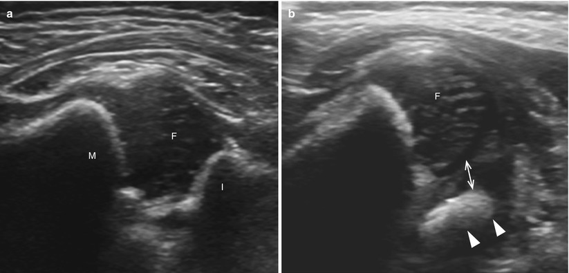 transverse presentation hip ultrasound