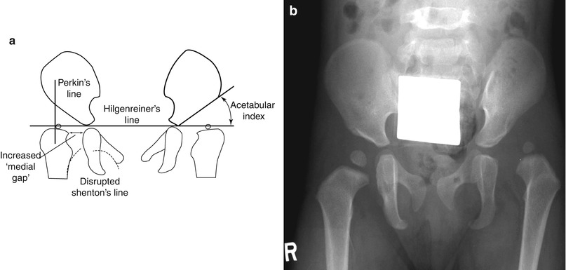 normal pediatric hip xray