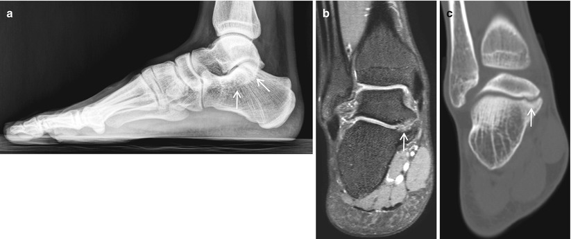 Miscellaneous Musculoskeletal Disease | Radiology Key