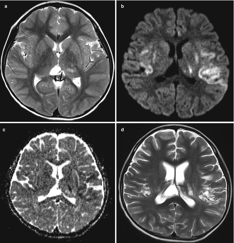 Infection and Inflammatory Diseases of the Central Nervous System ...