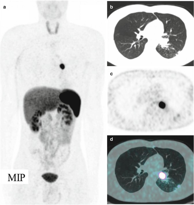 Neuroendocrine Tumors Radiology Key