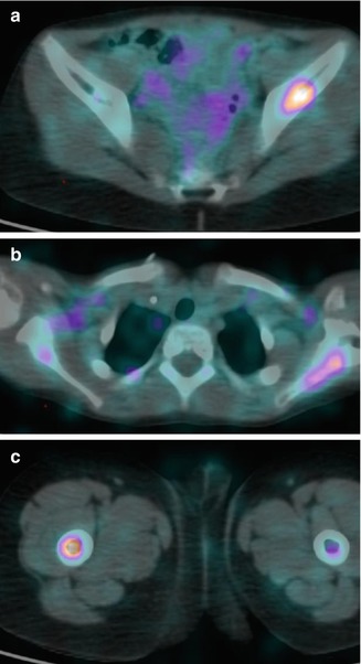 Neuroblastoma | Radiology Key