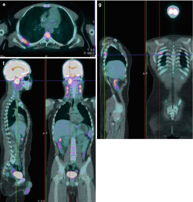 Pediatric Nasopharyngeal Carcinoma Radiology Key