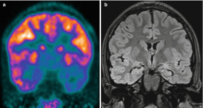 brain pet scan epilepsy