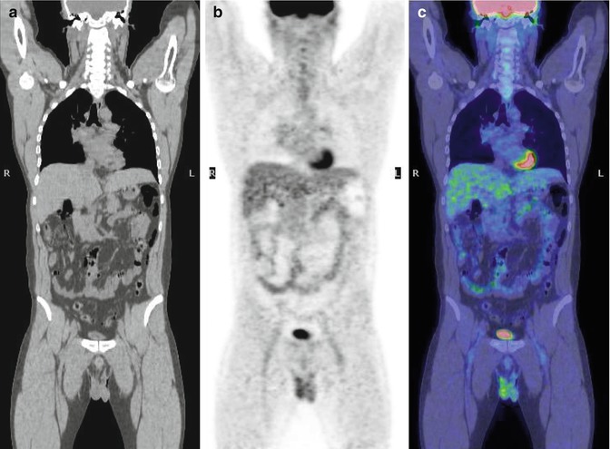 Autoimmune Lymphoproliferative Syndrome | Radiology Key