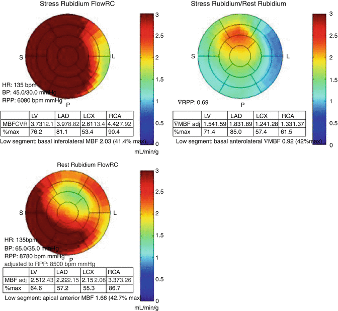 Myocardial Perfusion Imaging with 82Rb Cardiac PET/CT | Radiology Key