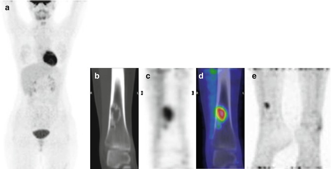 18f Fdgpetct In Pediatric Lymphoma Radiology Key