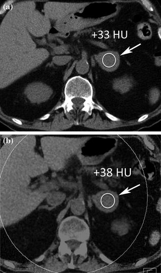 Adrenal Glands Radiology Key 0168